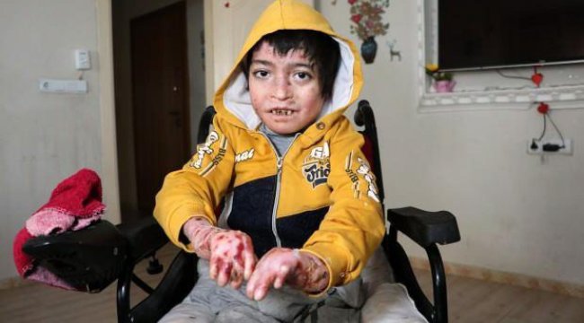 14 yaşındaki kelebek hastası Seyfettin parmaklarına kavuştu